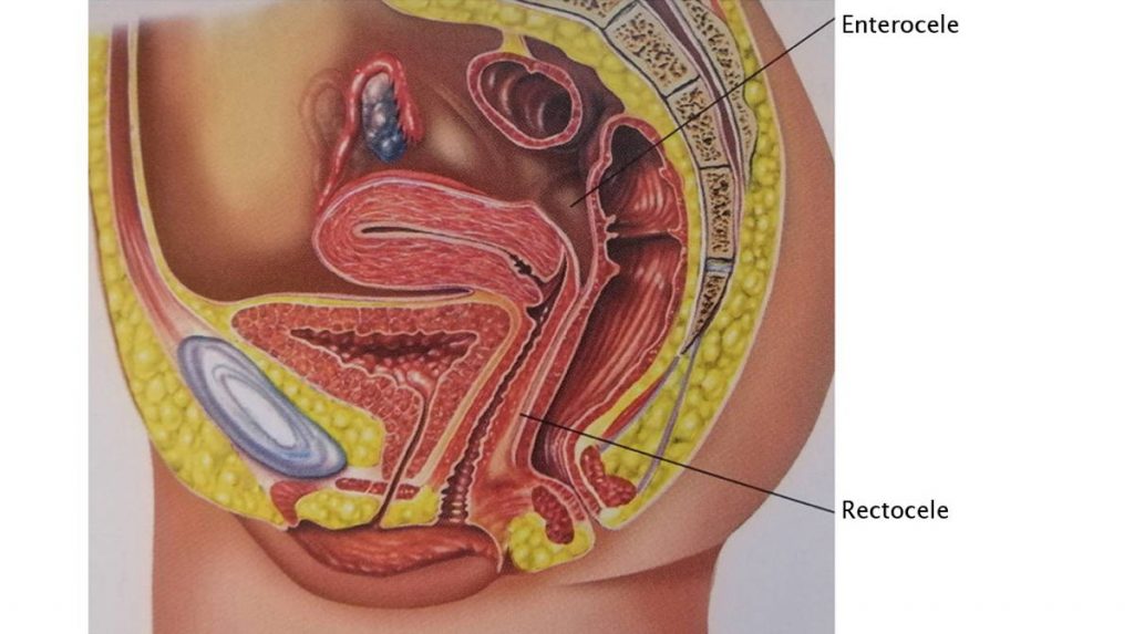 Figura 7. Lesión de la fascia rectovaginal y los ligamentos relacionados con ella, ligamentos cardinales (LC) y uterosacros (LUS), ocasionan rectocele. Cuando la lesión se produce en la parte apical de la fascia rectovaginal, puede causar enterocele.