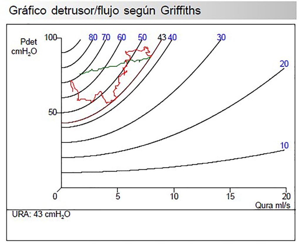 Figura 7. Gráfico detrusor/flujo según Griffths. En el estudio urodinámico de la Figura 6, calcula un URA de 43 (obstrucción).