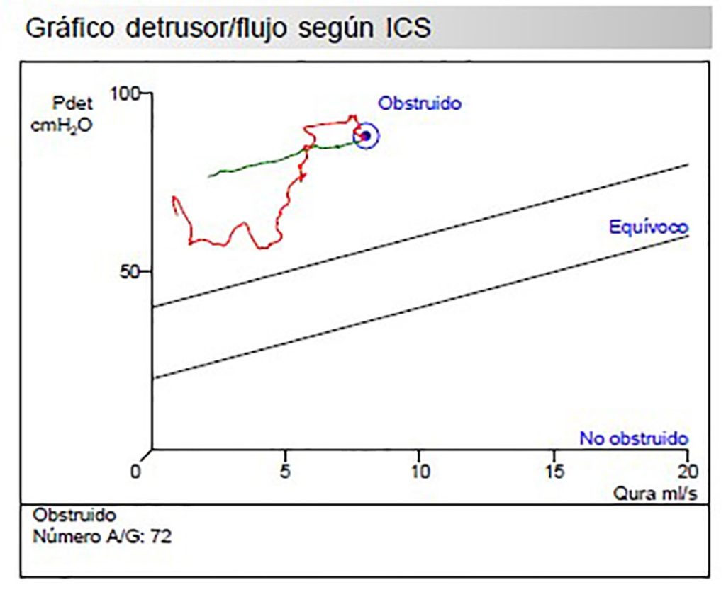 Figura 8. Gráfico detrusor flujo según ICS con cálculo del número de Abrams/Griffiths de 72 (obstrucción).
