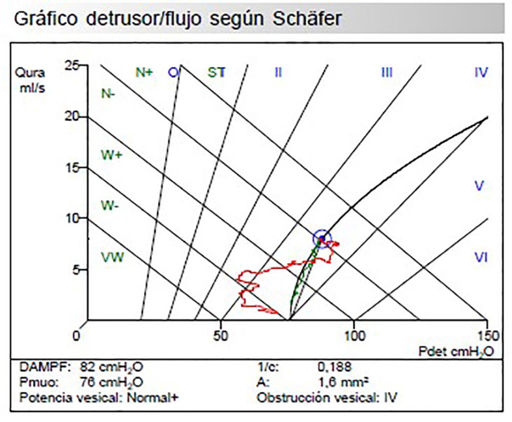Figura 9. Gráfico detrusor/flujo según Schäfer. Muestra una obstrucción moderada (zona IV) del tracto urinario inferior con una contractilidad del detrusor normal. El DAMPF de 82 indica obstrucción.