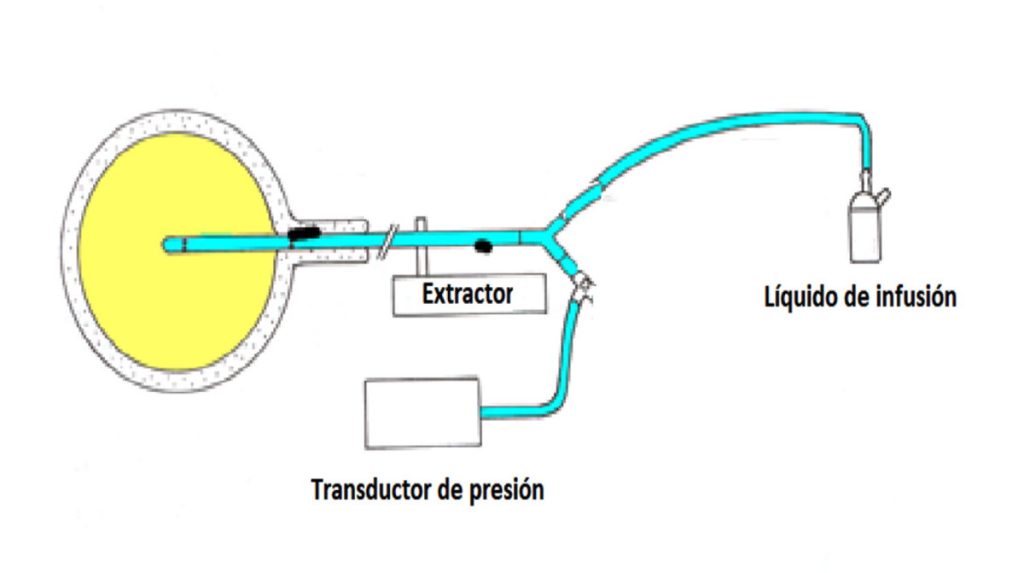 Figura 10. Esquema de conexión del catéter de perfusión.