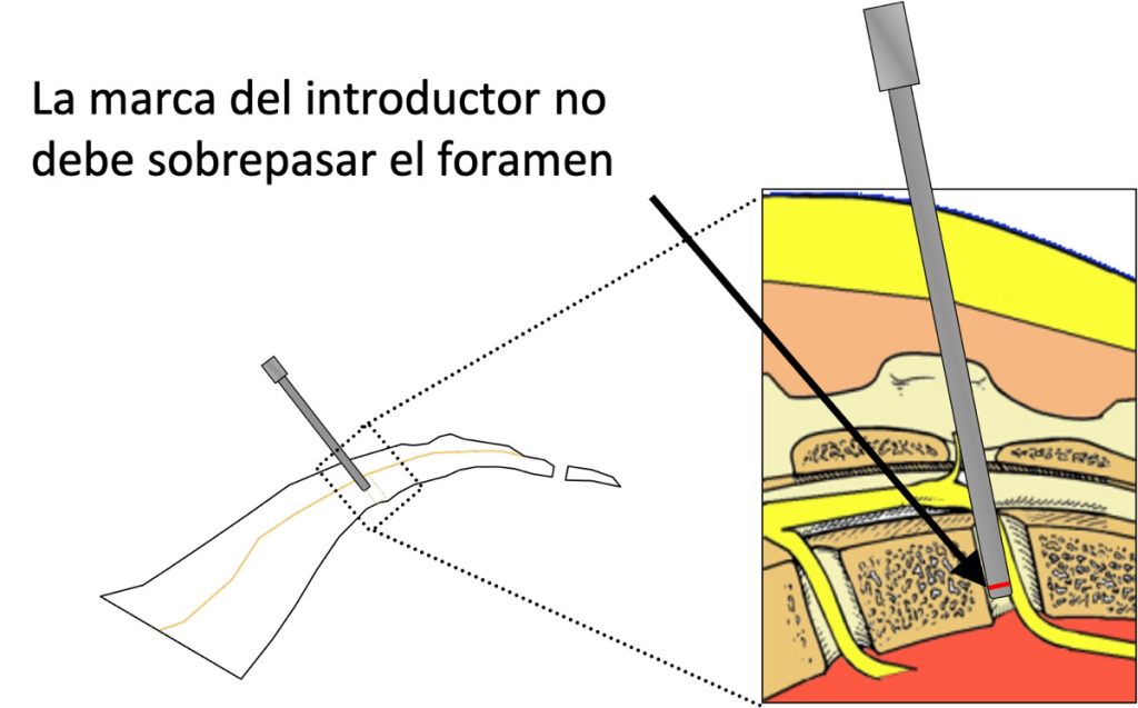 Figura 9. La marca radio-opaca del introductor no debe sobrepasar el foramen.