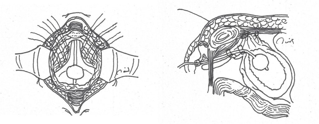 Figura 1. Técnica de Marshall-Marchetti-Krantz. Colocación de las suturas al periostio del pubis y resultado final.