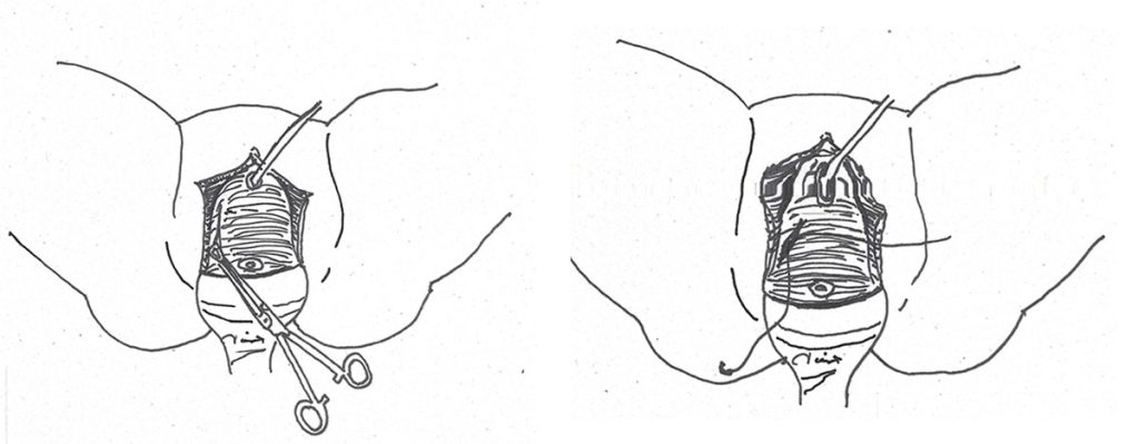 Figura 3. Colposuspensión modificada de Moreno. Tracción de fascia pubocervical y sutura helicoidal.