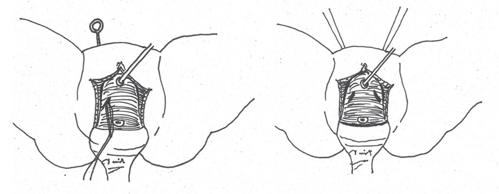 Figura 4. Colposuspensión modificada de Moreno: paso de hilos de sutura con aguja de Stamey hacia posición retropúbica.