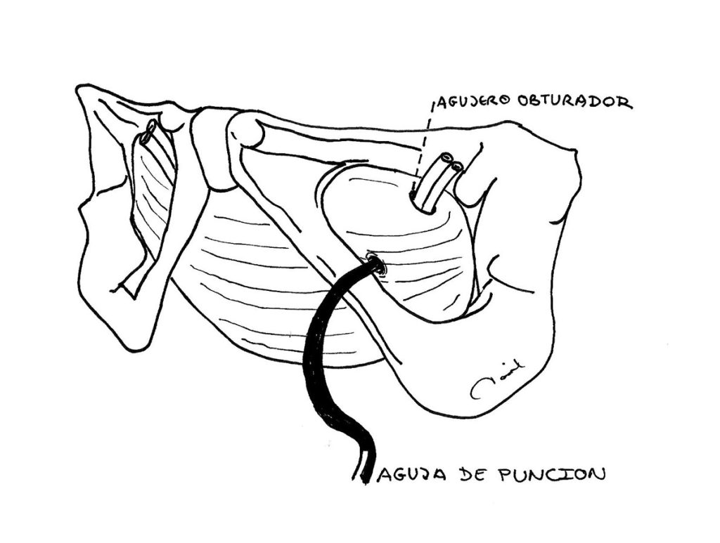 Figura 3. Paso de la aguja a nivel del agujero obturador. Ilustrador: David García Gutiérrez.