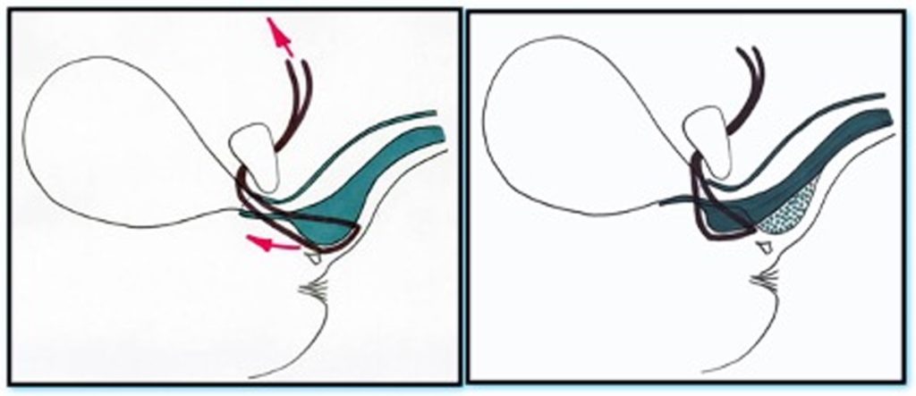 Figura 5. Mecanismo de acción del TOT Advance XP®: recolocación craneal del bulbo uretral de forma paralela a la luz uretral.