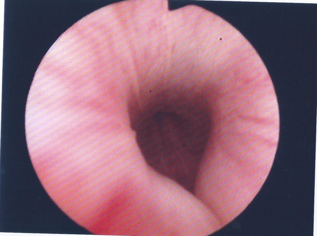 Figura 10. Ajuste guiado endoscópicamente. Se aprecia cómo la malla produce una impronta en la uretra. Al fondo, se puede ver el esfínter uretral.