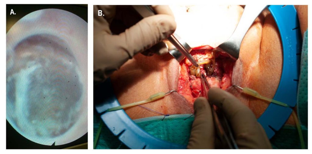 Figura 4. A. Erosión uretral: esfínter urinario artificial Zephyr®. B. Erosión uretral. Explante: lesión uretral.