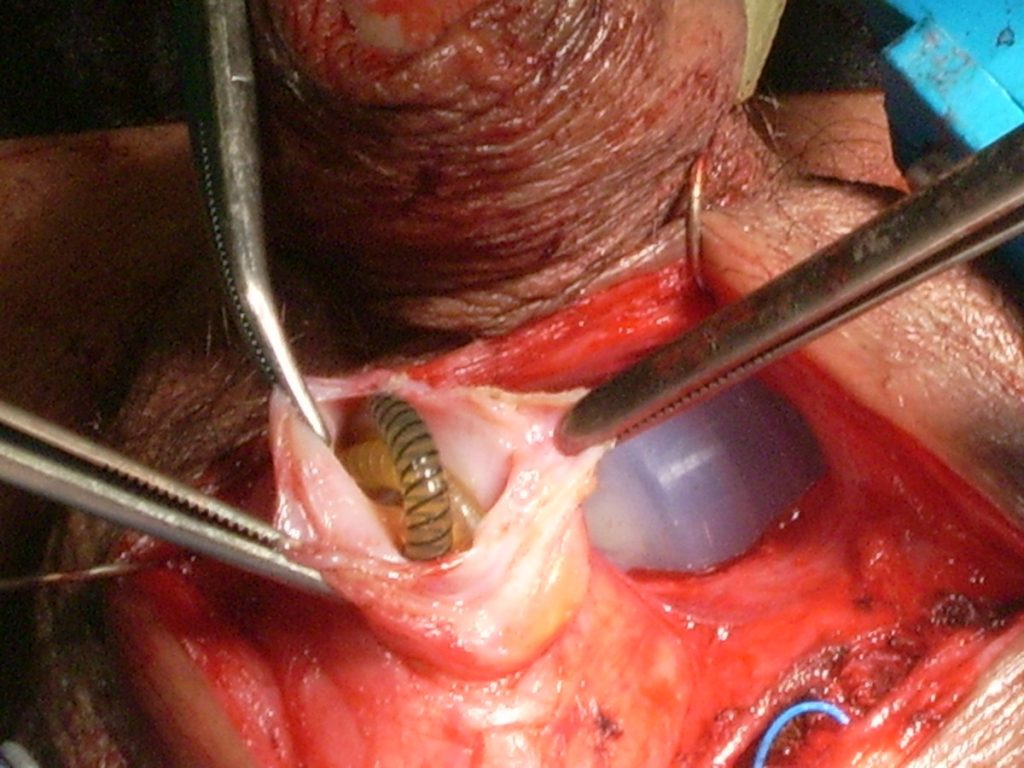 Figura 11. Reubicación quirúrgica de bomba escrotal.