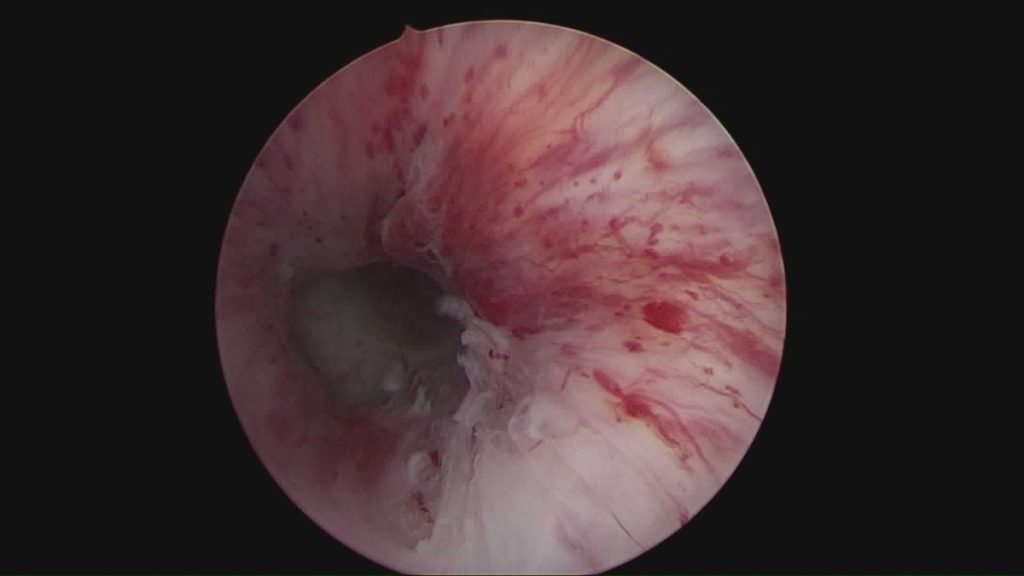 Figura 22. Laceración uretral tras manipulación endoscópica en esfínter previamente desactivado.