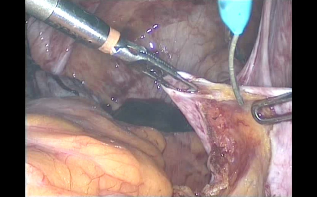 Figura 9. Disección medial a ligamentos uterosacros.