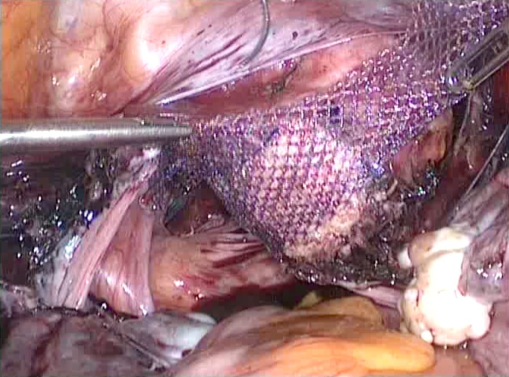 Figura 12. Fijación de malla al cérvix.