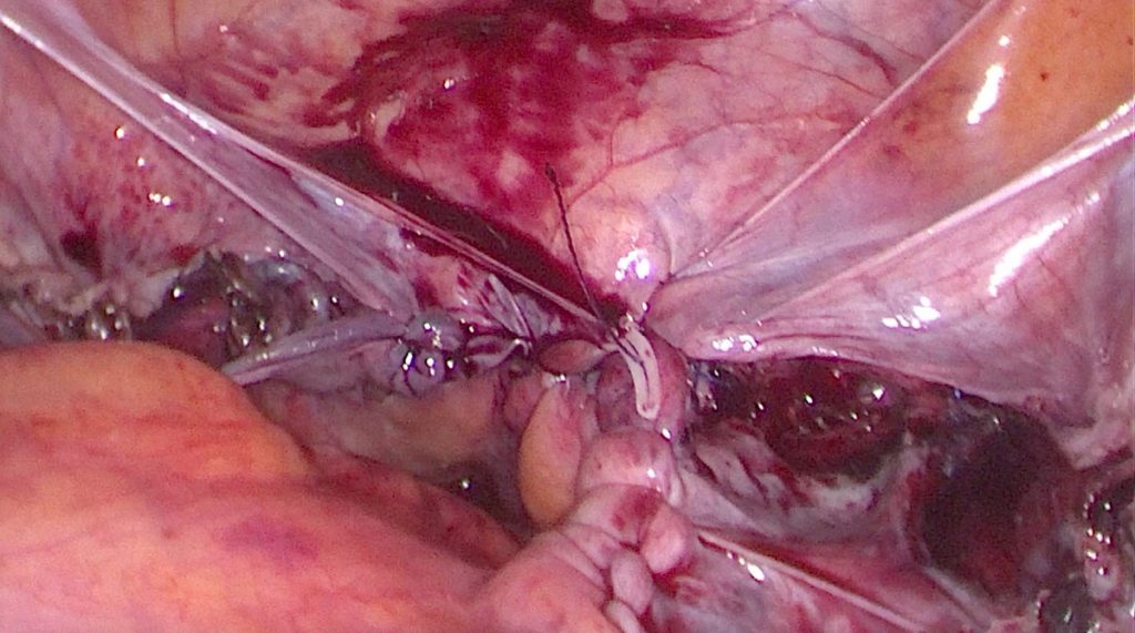 Figura 15. Cierre de peritoneo para evitar exposición de mallas.