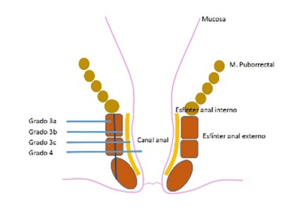 Figura 1. Afectación anatómica según la profundidad del desgarro.